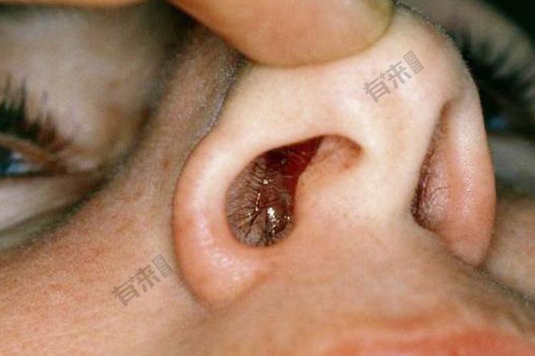 鼻息肉是什么症状